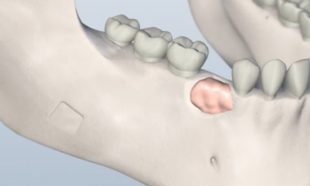 bone grafting