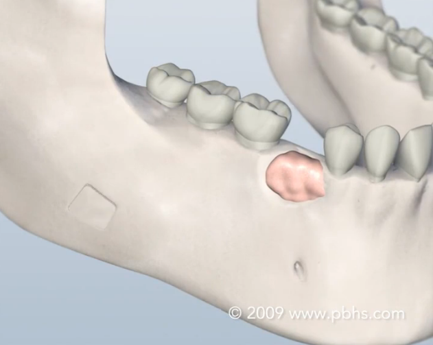 bone grafting