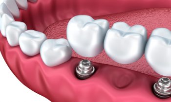 Dental Implants Chattanooga