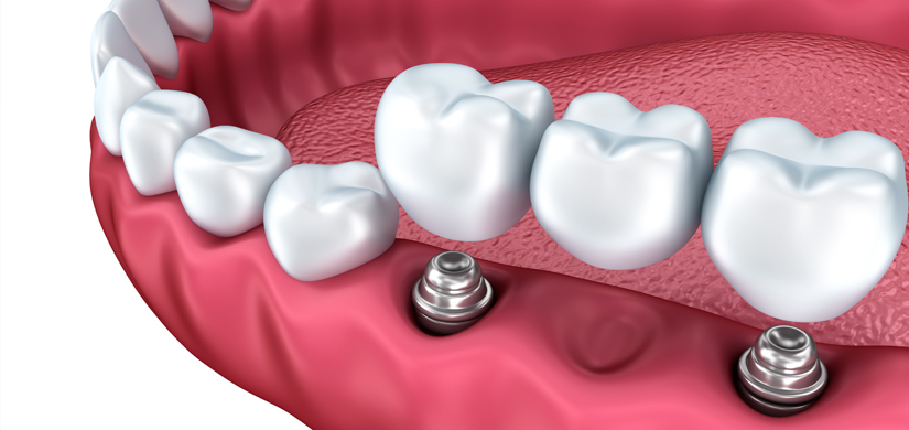 Dental Implants Chattanooga