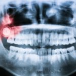 signs your wisdom teeth may be a problem