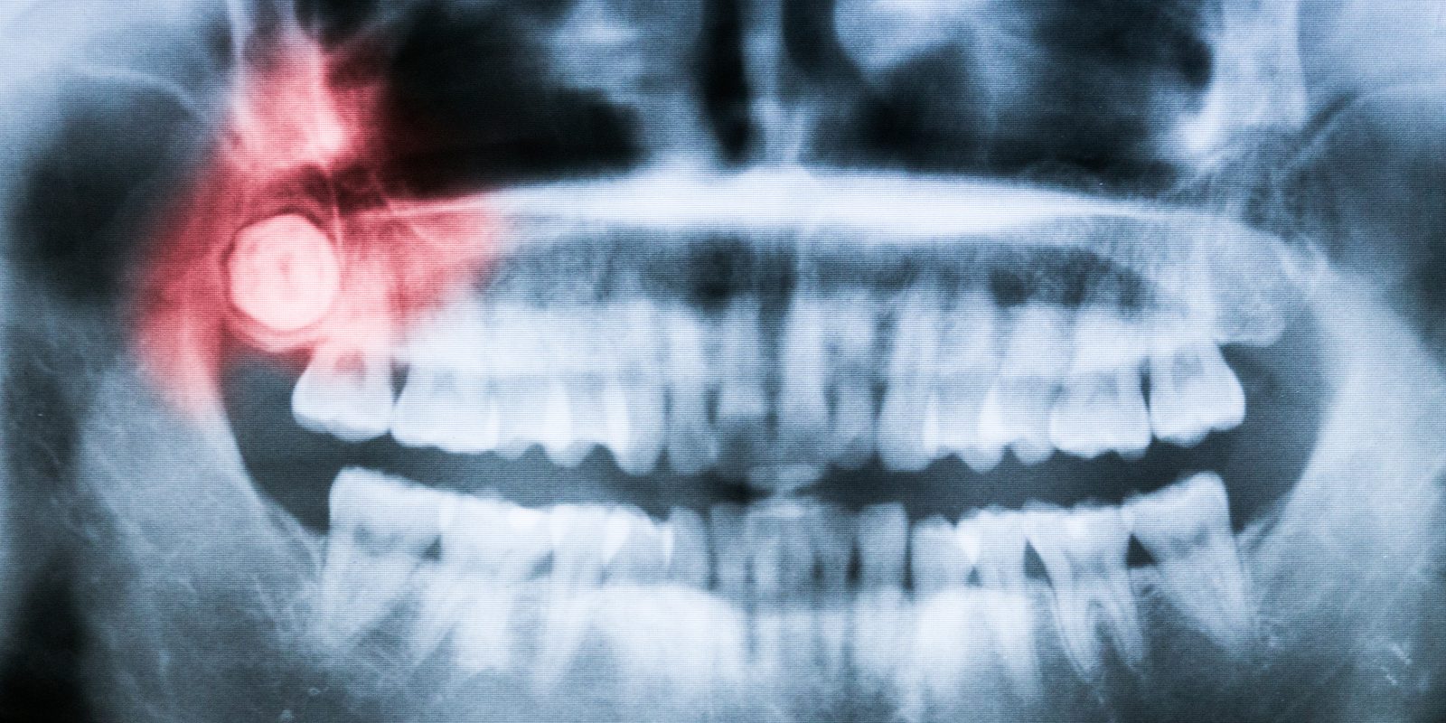 signs your wisdom teeth may be a problem