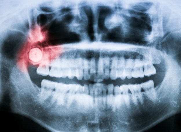 signs your wisdom teeth may be a problem