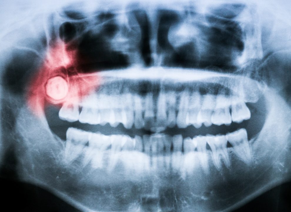 signs your wisdom teeth may be a problem