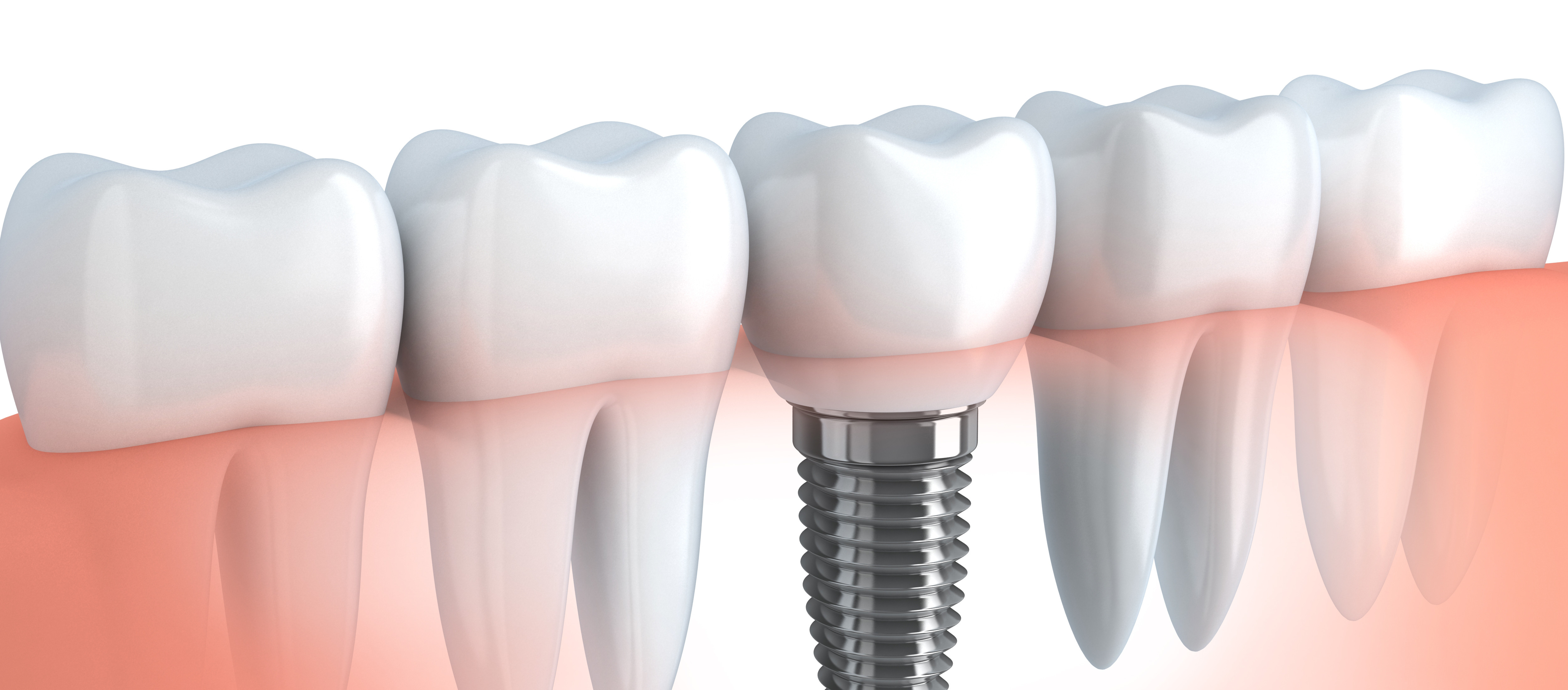 dental implant safety
