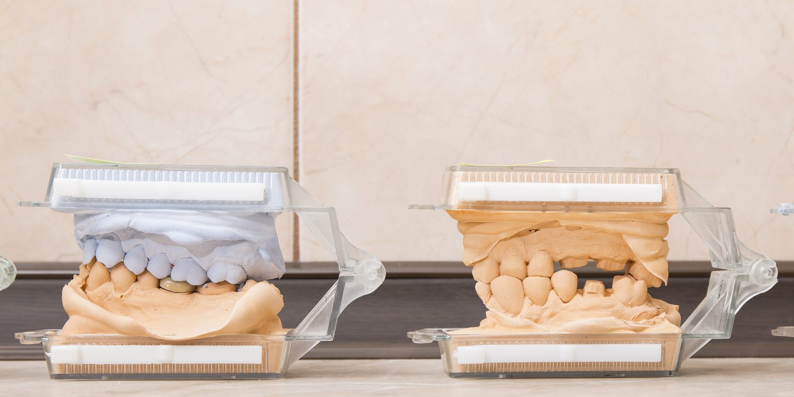 how to choose the best dental implant