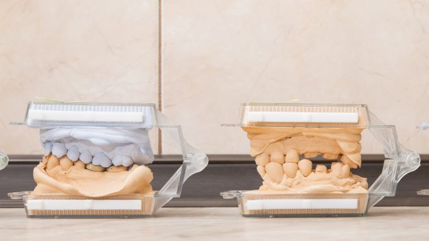 how to choose the best dental implant