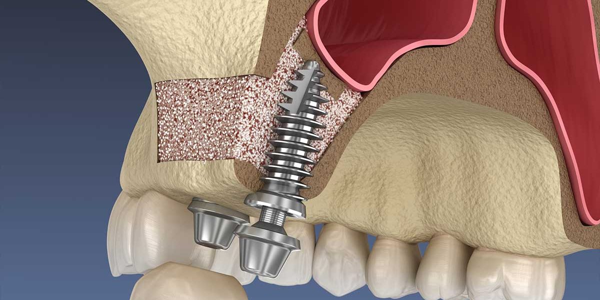 How Can a Sinus Lift Benefit Your Health