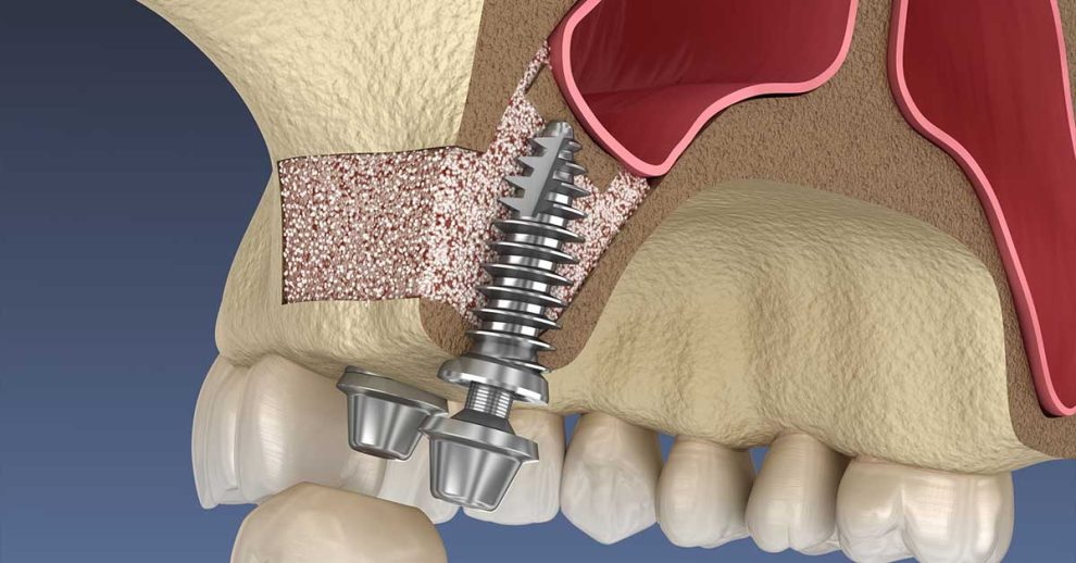 How Can a Sinus Lift Benefit Your Health