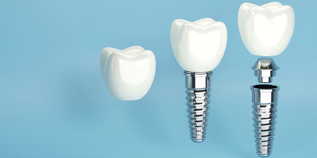 What if Your Dental Implant Gets Damaged