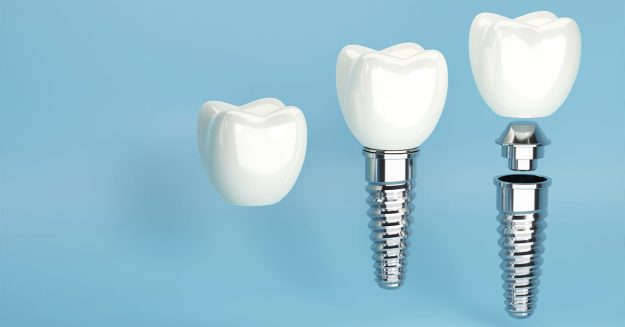 What if Your Dental Implant Gets Damaged