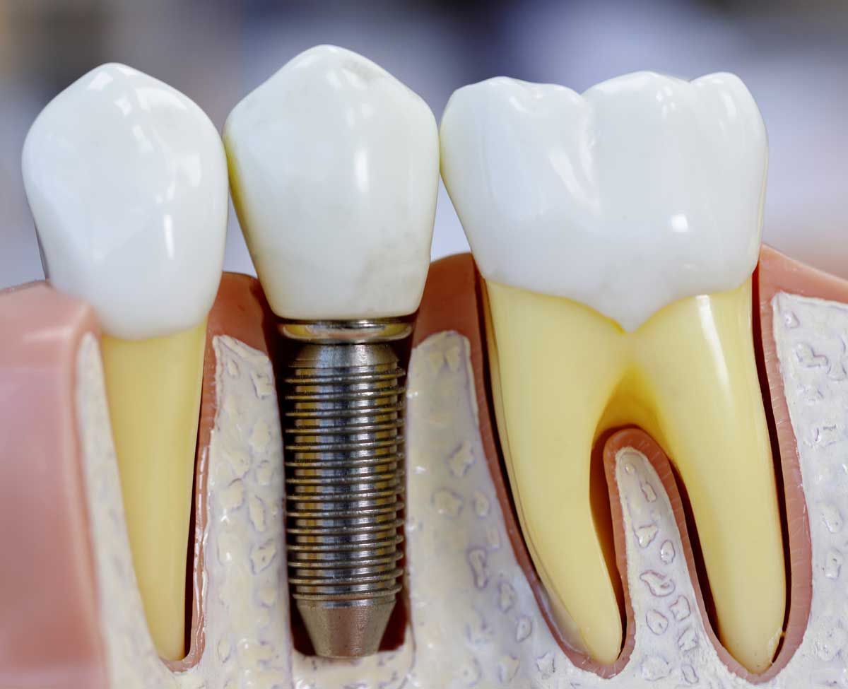 dental implant surgery post operative instructions