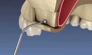 Sinus Lift Surgery in Chattanooga TN