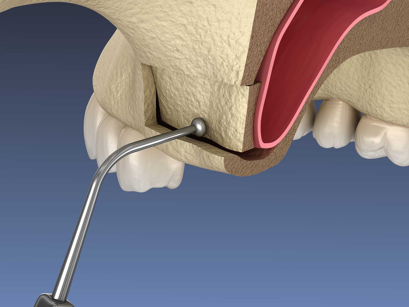 Sinus Lift Surgery in Chattanooga TN